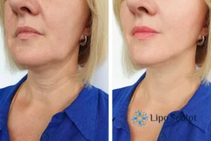 Double chin before and after Hi-Fu treatment 4 Book your double chin treatment Nottinghamshire today! We are here to help!