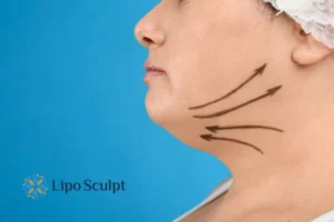 Double chin before and after Hi-Fu treatment 3 Boost your confidence with a Double chin treatment Nottinghamshire