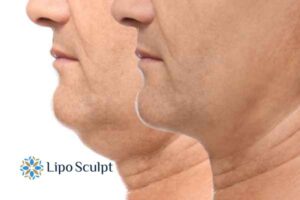 Double chin before and after Hi-Fu treatment 2 Double chin treatment Nottinghamshire from Lipo Sculpt - feel more confident today!