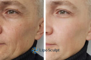 How to Fight Aging Symptoms 3 Fight Aging Symptoms Nottinghamshire With HIFU and Morpheus8 Today!