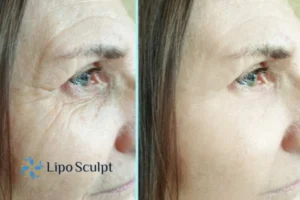 How to Fight Aging Symptoms 2 Do you want to Fight Aging Symptoms Nottinghamshire? Contact Lipo Sculpt today!