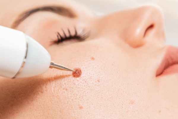 CryoPen: 5 Skin Concerns It May Be Used to Treat 3 What actually happens during a CryoPen treatment Nottinghamshire?