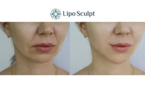 Explaining Total Skin Tightening Treatment And What It Can Do For You 2 Do you want to boost your self confidence? Give Morpheus8 Nottinghamshire a try today!