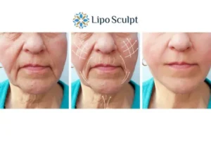 Explaining Total Skin Tightening Treatment And What It Can Do For You 3 Boost your confidence with Morpheus8 Nottinghamshire call our team today!