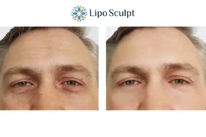 Explaining Total Skin Tightening Treatment And What It Can Do For You 6 Morpheus8 Nottinghamshire book in today to find out more!