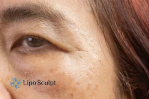 Cryopen: The Revolutionary Treatment for Age Spots Unveiled 2 Are age spots Nottinghamshire giving you low self esteem? Contact us today!