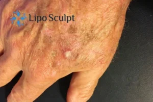 Best Actinic Keratoses Removal 2 Improve your wellbeing and health with Actinic Keratoses Nottinghamshire removal.treatment