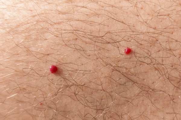 CryoPen: 5 Skin Concerns It May Be Used to Treat 2 cherry angioma removal Nottinghamshire