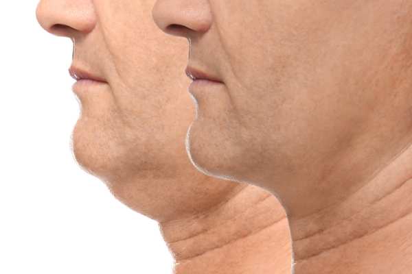 Book your Chin Reduction Treatment Nottinghamshire today!