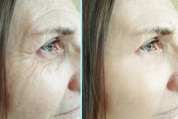 Why Do People Choose HIFU for a Non-Surgical Facelift? 4 How long can HIFU results last Nottinghamshire?