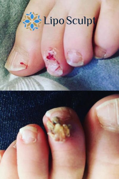 Wart removal customer results from Lipo Sculpt Nottinghamshire