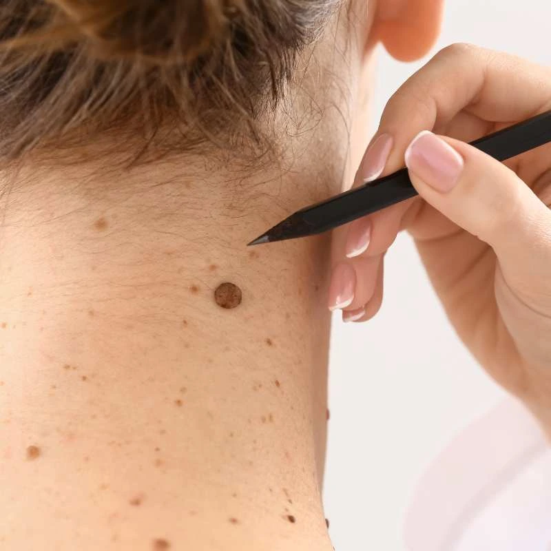 How to Support Your Body During Pregnancy for Faster Postnatal Recovery 5 See our lesion removal prices Nottinghamshire - call today for a free quote