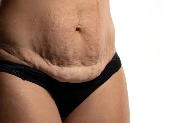 Lost the Weight but Not the Loose Skin? 1 image of womans stomach after weight loss showing loose skin Nottinghamshire